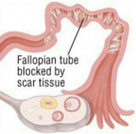 Herbal Treatment For Blocked Fallopian Tubes In Nigeria Nigerian