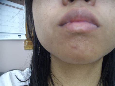 April 172013 Scar On Chin Progress Pictures Of My Acne Red Marks