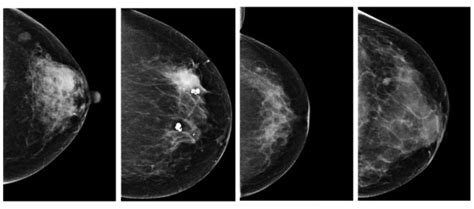 Ai Rivals Human Radiologists At Breast Cancer Detection Physics World