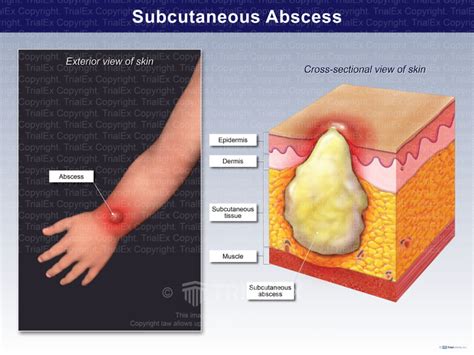 subcutaneous abscess trial exhibits inc
