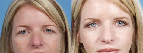 Eyelid Surgery Before And After Pictures Case 62 Chicago Il Tlkm Plastic Surgery