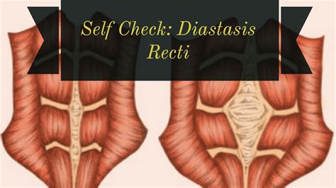 How To Check For Diastasis Recti Diastasis Diastasis Recti Reverasite