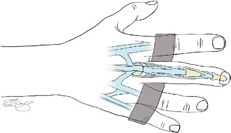 Full Fist Flexion In Relative Motion Extension Splint After Extensor