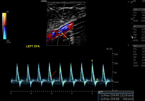 Figure Doppler Ultrasound Showing Typical Triphasic Statpearls