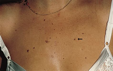 Instead of a perfect (or lopsided) circle, it is a weirdly shaped oval, squiggles, or even a blotch. A 10-Year-Old In Situ Melanoma? | Dermatology | JAMA ...