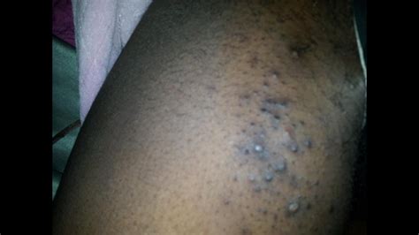 New black beauty 4 piece bump up hair high on hair. Ingrown Hair Treatments for Black Women (Miami, Fl) - YouTube