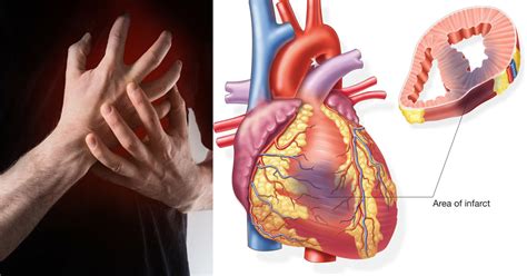 Myocardial Infarction Heart Attack Top Neuro Docs