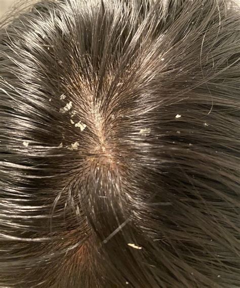 Seborrheic Dermatitis Hair Loss Reddit Debrah Morrell