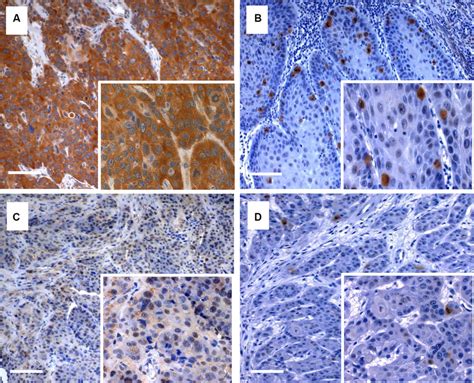 Immunohistochemical staining of Plk3 and pT273 caspase-8. Examples of 