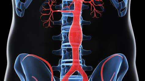What To Know About Ascending Aortic Aneurysm After Grant Wahls Sudden