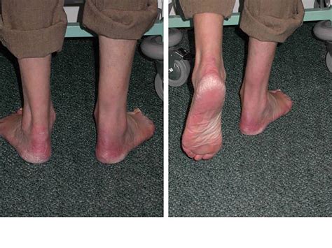 Flexor Hallucis Longus Transfer 03 1 The Foot And Ankle Clinic