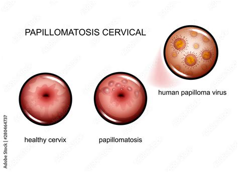 Cervical Papillomatosis Human Papilloma Virus Vector Illustration My XXX Hot Girl