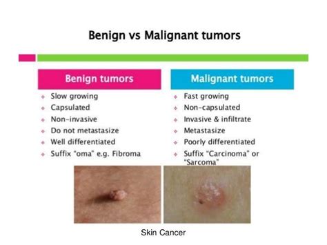 Malignant Tumor Vs Benign Tumor Lab