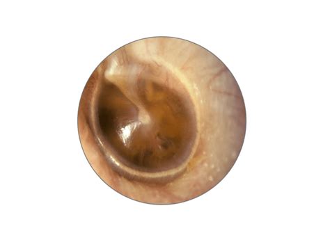 Clinical Examination Of The Ear