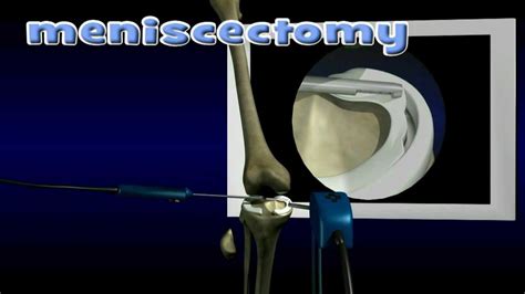 Meniscus Repair And Meniscectomy Youtube