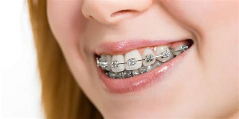 Für viele junge professionals sind die feste zahnspange durchsichtig kosten kein problem, während eine offensichtliche zahnspange dein seriöses auftreten gefährden kann. Zahnspange