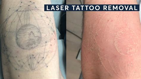 Laser Tattoo Removal Before And After Central London Youtube
