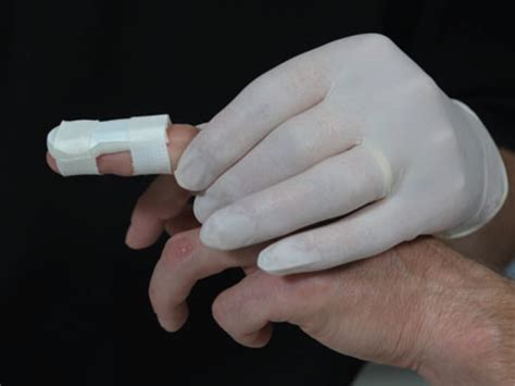 Jempol adalah salah satu dari jari tangan yang diberi istilah ibu jari. Pertolongan Pertama pada Patah Tulang Jari