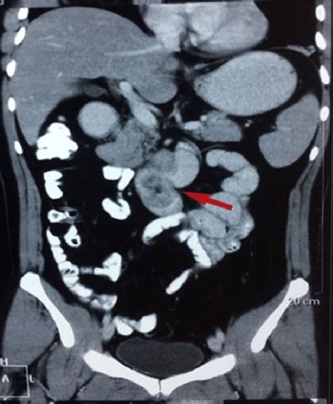 Ct Showing A Polypoid Lesion Extending From The First Part Of The