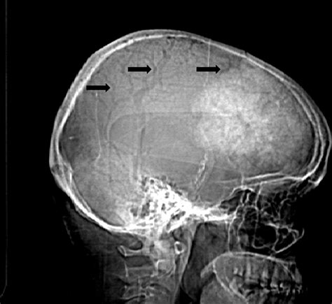 Giant Meningioma In Skull Radiograph Bmj Case Reports