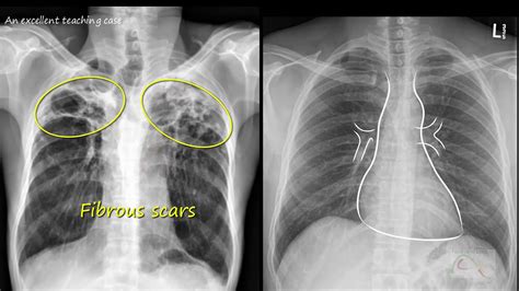 Ptb Xray Cureus Endobronchial Tuberculosis A Rare Presentation