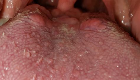 Are Bumps On Back Of Tongue Normal What Could Be Happening
