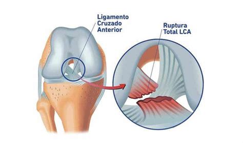 fisioterapia para el ligamento cruzado anterior de rodilla avanfi
