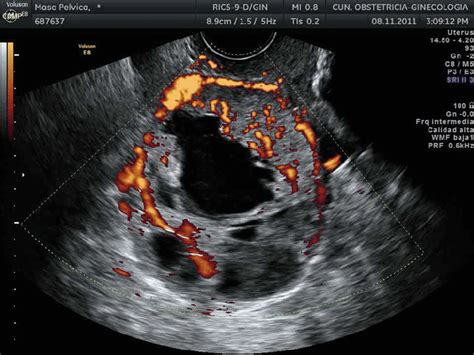 Transvaginal Ultrasound Showing A Cysticsolid Mass With Abundant