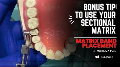Matrix Band Placement Bonus Tip To Use Your Sectional Matrix Youtube