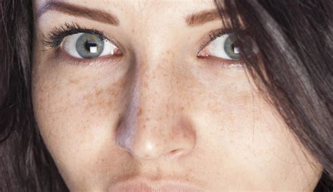 Dark Spots On The Skin Causes And How To Treat Them Wecare