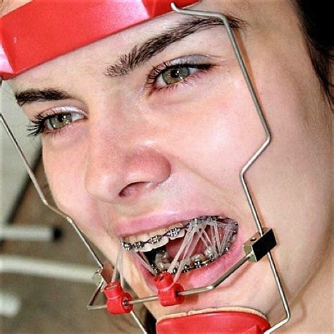 Adult Braces Braces Girls Dental Braces Teeth Braces Orthodontic Appliances Brace Face