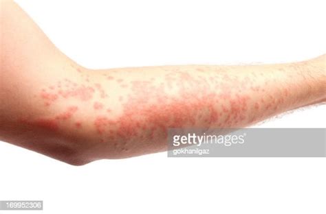 Skin Allergy Stock Photo Getty Images