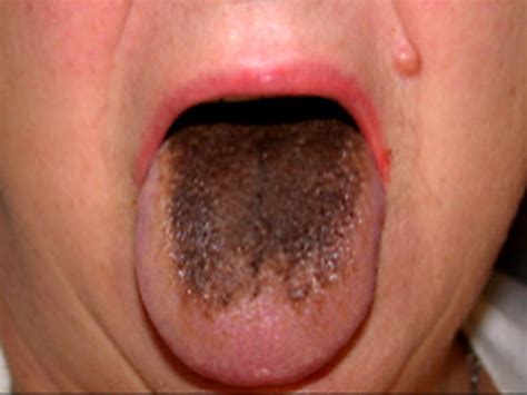 Coated White Tongue Foul Mouth What Yucky Signs Say About Your