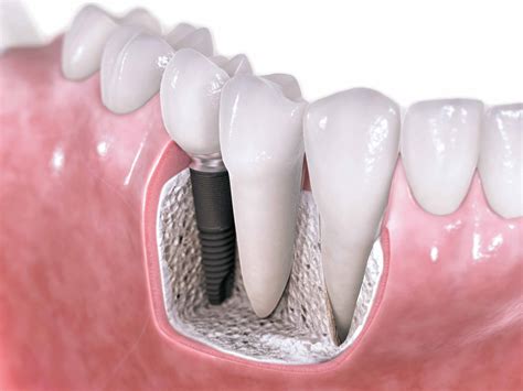 O Implante Dentário Dicas Odonto