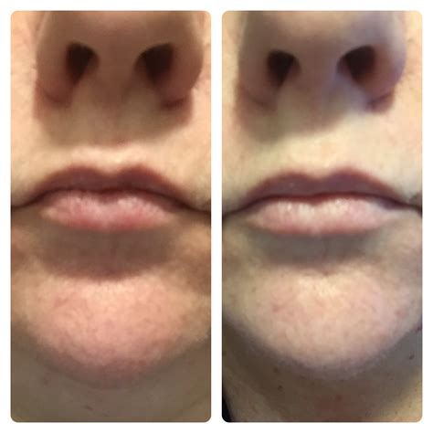 Before And After 1 Week Probiotic Skin Care Skin Care Skin