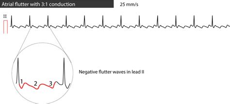 Atrial Flutter Classification Causes Ecg Diagnosis And Management