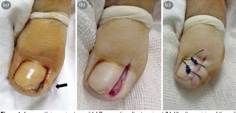 Pdf Partial Removal Of Nail Matrix In The Treatment Of Ingrowing Toe