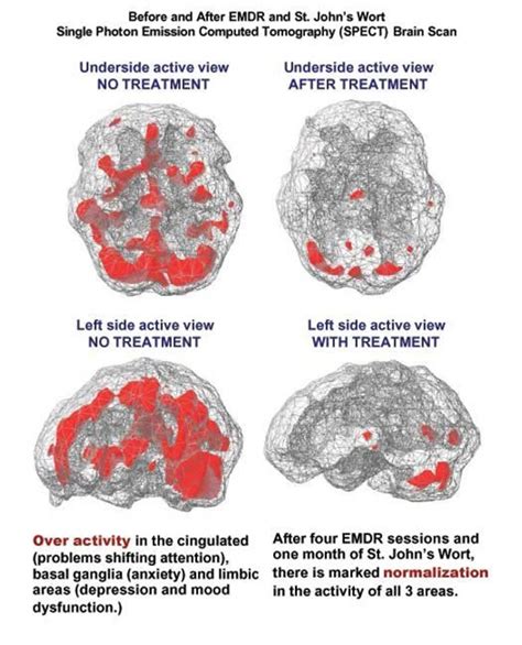 Gulin Aydin Msw Rsw Brain Scan Before And After Emdr