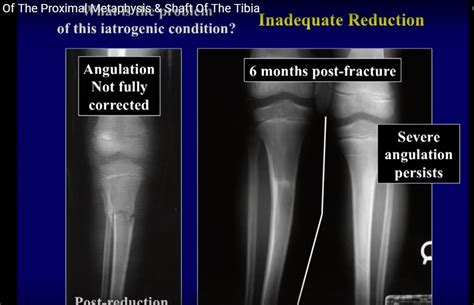 Proximal tibia fractures refer to fractures of the upper portion of tibia below the knee. Fractures Of the Tibia in Children — OrthopaedicPrinciples.com