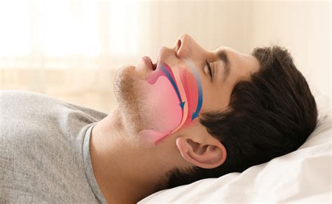 5 modi per riconoscere le apnee notturne | Pazienti.it