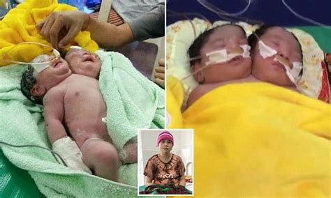 Conjoined Female Twins Have Been Born With One Body And Two Heads
