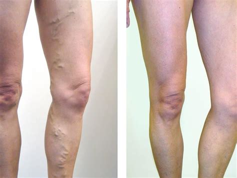 Sclerotherapy Laser Vein Removal Utah Valley Dermatology