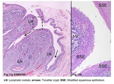 Tonsillitis And Adenoiditis Causes Diagnosis And Treatment