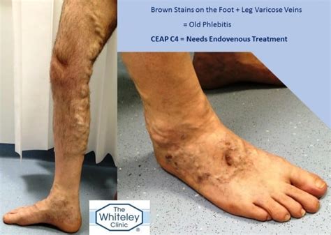 Brown Stains On Feet Phlebitis From Varicose Veins