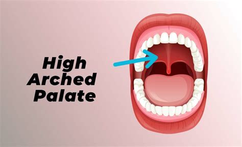 High Arched Palate Main Causes And How To Fix It Mga Dental Clinic