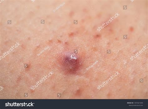 Infected Hair Follicle Images Stock Photos And Vectors Shutterstock