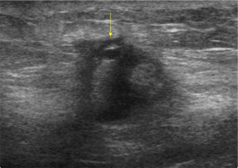 Imaging Features Of Breast Malignancy Breast Ultrasound And Mr Imaging
