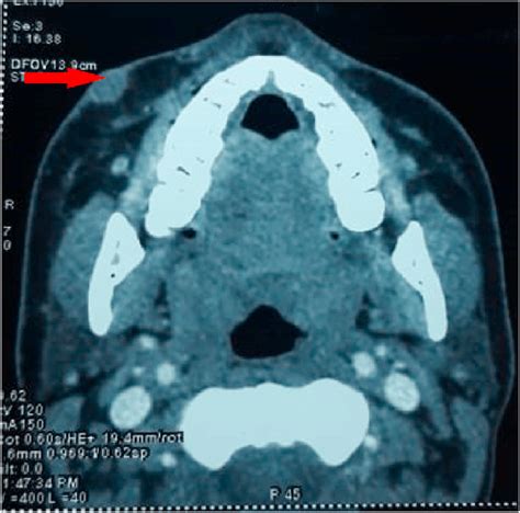 Axial Section Ct Scan Of The Face Showing The Soft Tissue