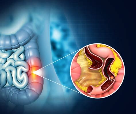 Signs And Symptoms Of Colon Cancer