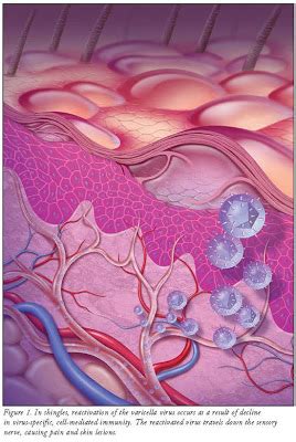 It affects most people on one or more occasions during their lives. PhysioBLOGology2: Herpes Zoster